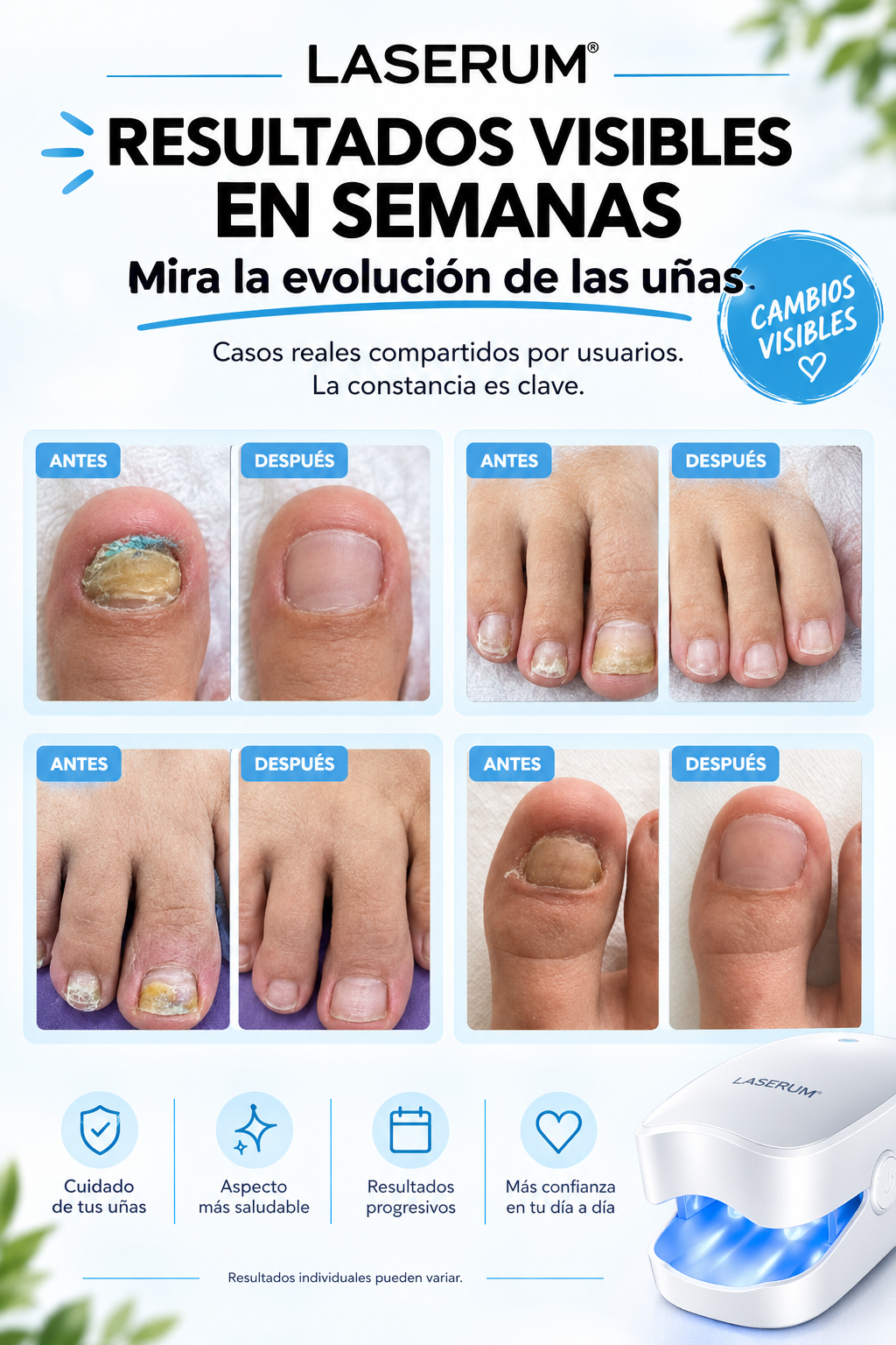 LASERUM®-Dispositivo Láser para Cuidado de las Uñas